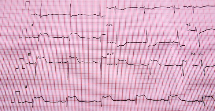 心電図-STEMI-ST上昇と心筋梗塞の徴候