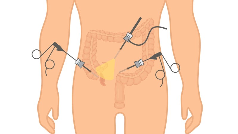 虫垂炎における腹腔鏡検査のモデル表現