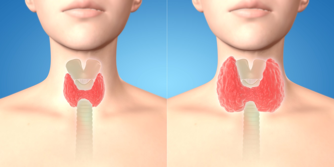 甲状腺腫脹の観察と触診 - 甲状腺腫