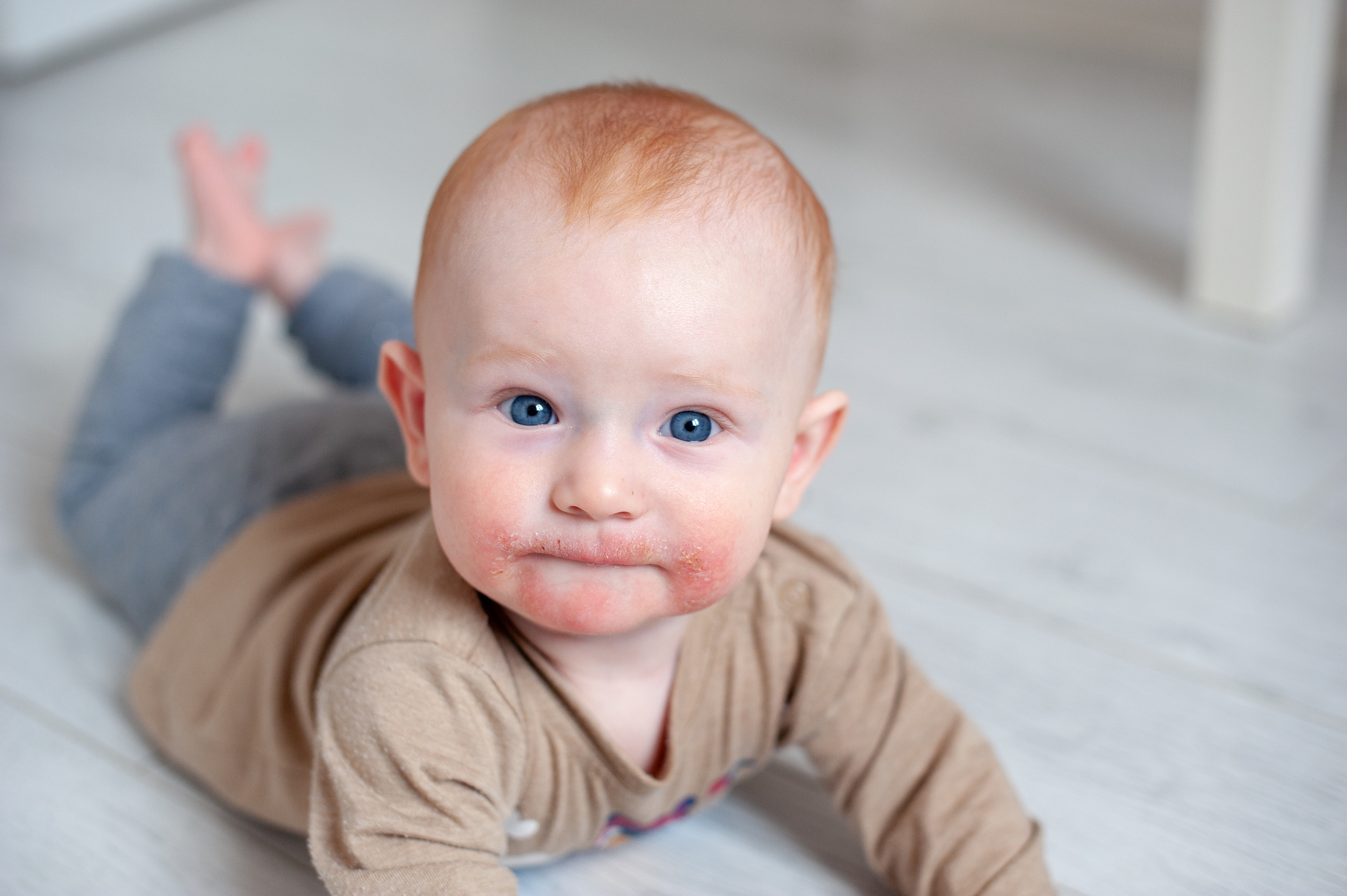 子供の顔のアトピー性皮膚炎