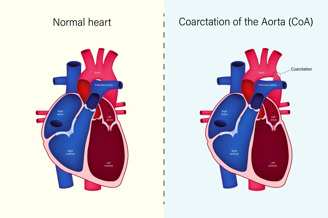 心臓の生理学的状態と大動脈梗塞（CoA）