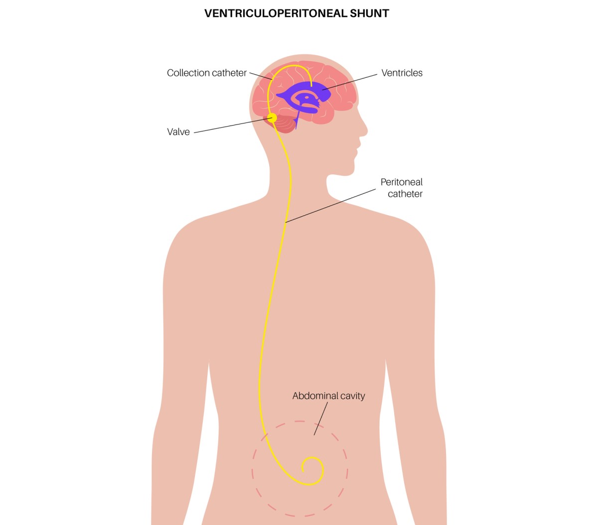 脳から余分な体液を腹腔内に排出する脳室腹腔シャントの図。