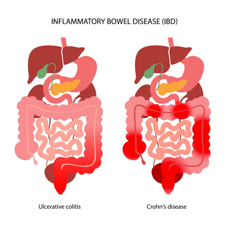 IBD：炎症反応の局在により潰瘍性大腸炎とクローン病に分けられる。