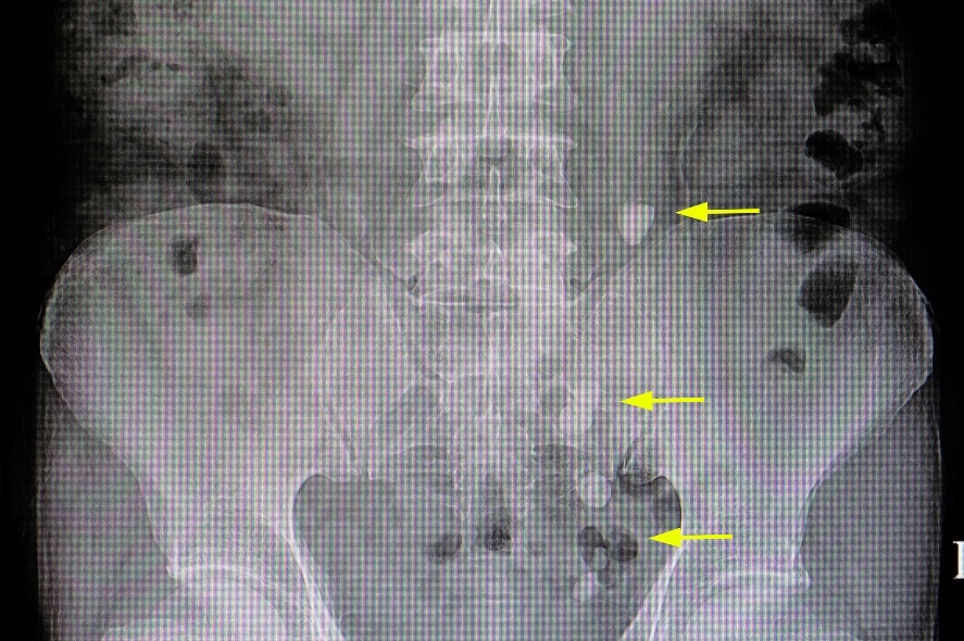 X線：尿路のコースに多数のコンクリートがある