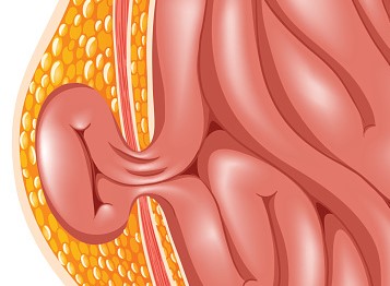 腹水の最も一般的な合併症であるヘルニア