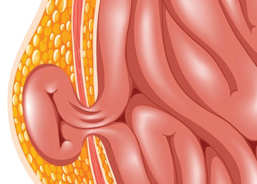 ヘルニアのモデル、すなわち腹壁ヘルニア