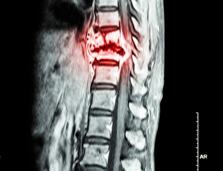 胸椎のX線検査で、胸椎に癌の所見がある。