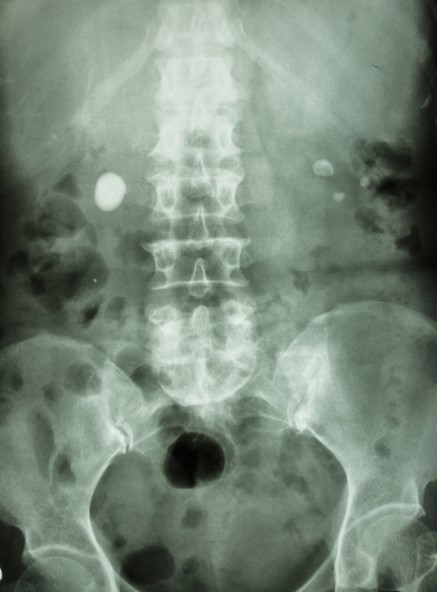 腹部のX線検査で、両側の腎臓に腎結石がある。