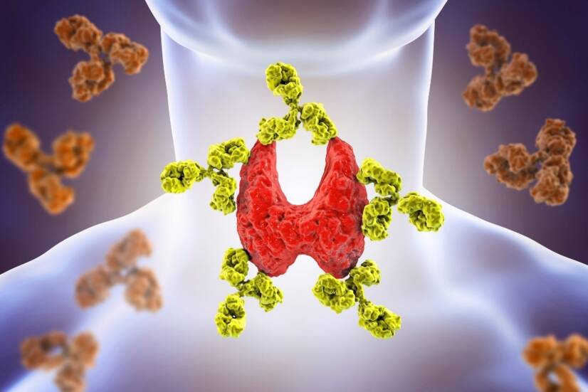 自己免疫性甲状腺炎：橋本病 原因、症状