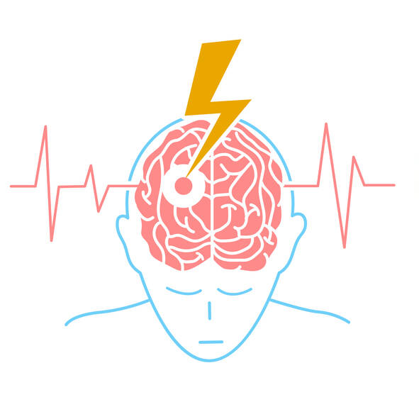 脳卒中とは何か、症状、リスク、治療法をご存知ですか？