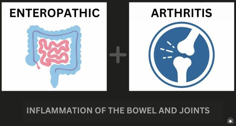 腸炎性関節炎と炎症性腸疾患：両者の関係＋症状