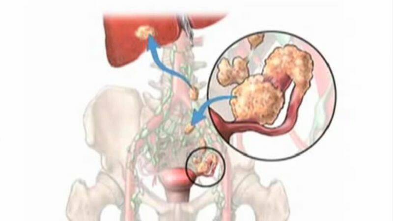 卵巣嚢腫：破裂は危険ですか？ 妊娠中はどうですか？